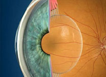 Catarata - Institudo de Olhos Limongi