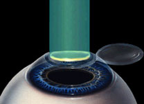 Cirurgia Refrativa - Institudo de Olhos Limongi