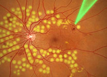 Fotocoagulador a laser - Institudo de Olhos Limongi