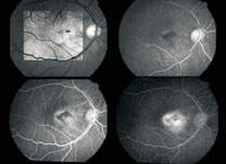Angiofluoresceinografia - Institudo de Olhos Limongi