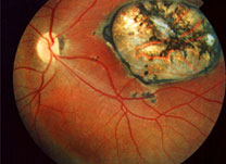 Retinografia - Institudo de Olhos Limongi