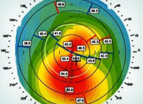 Topografia Computadorizada da Córnea - Institudo de Olhos Limongi