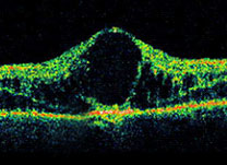 Tomografia de Coerência Óptica - Institudo de Olhos Limongi